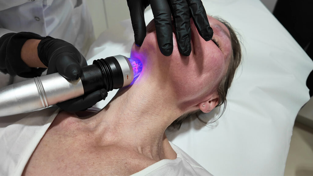 Radiofrekwencja mikroigłowa Warszawa