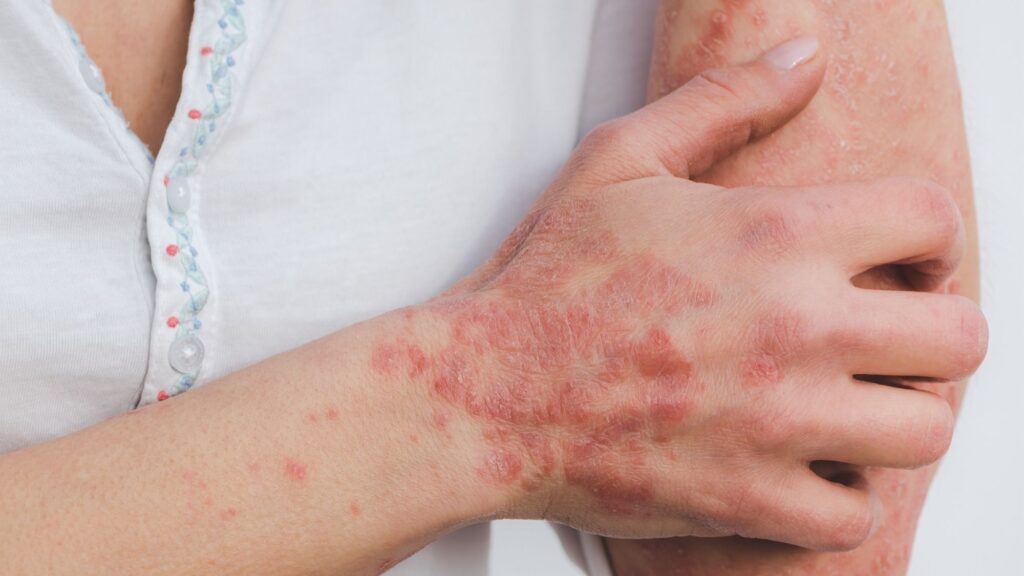 Leczenie łuszczycy fototerapia warszawa dagderm