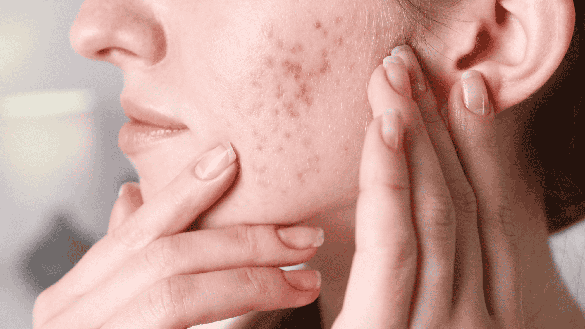 Trądzik Warszawa dermatolog