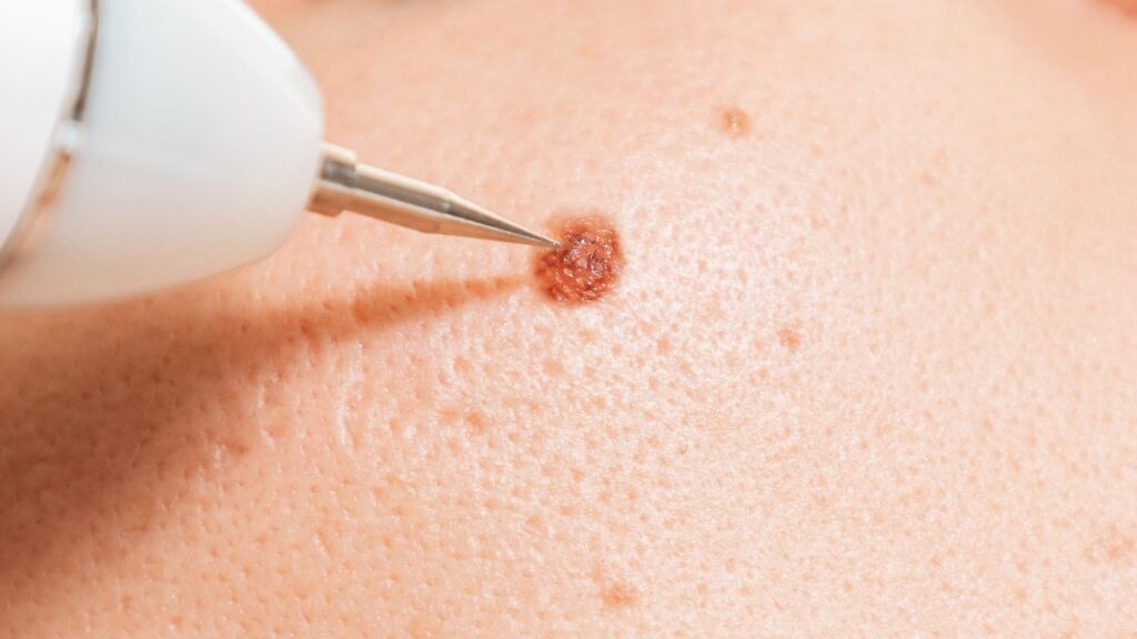 Usuwanie znamion Warszawa