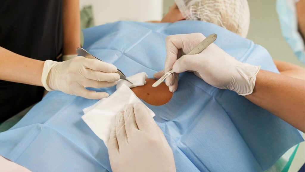 Usuwanie znamion Warszawa Dagderm