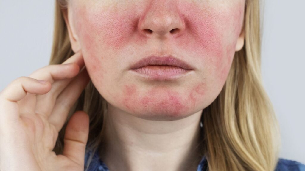 Dermatolog ocenia rumień i zmiany zapalne trądziku różowatego podczas konsultacji w Warszawie