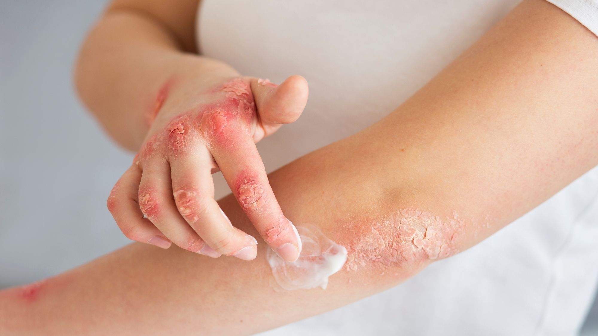 Konsultacja dermatologiczna w kierunku ŁZS i ocena skóry Warszawa