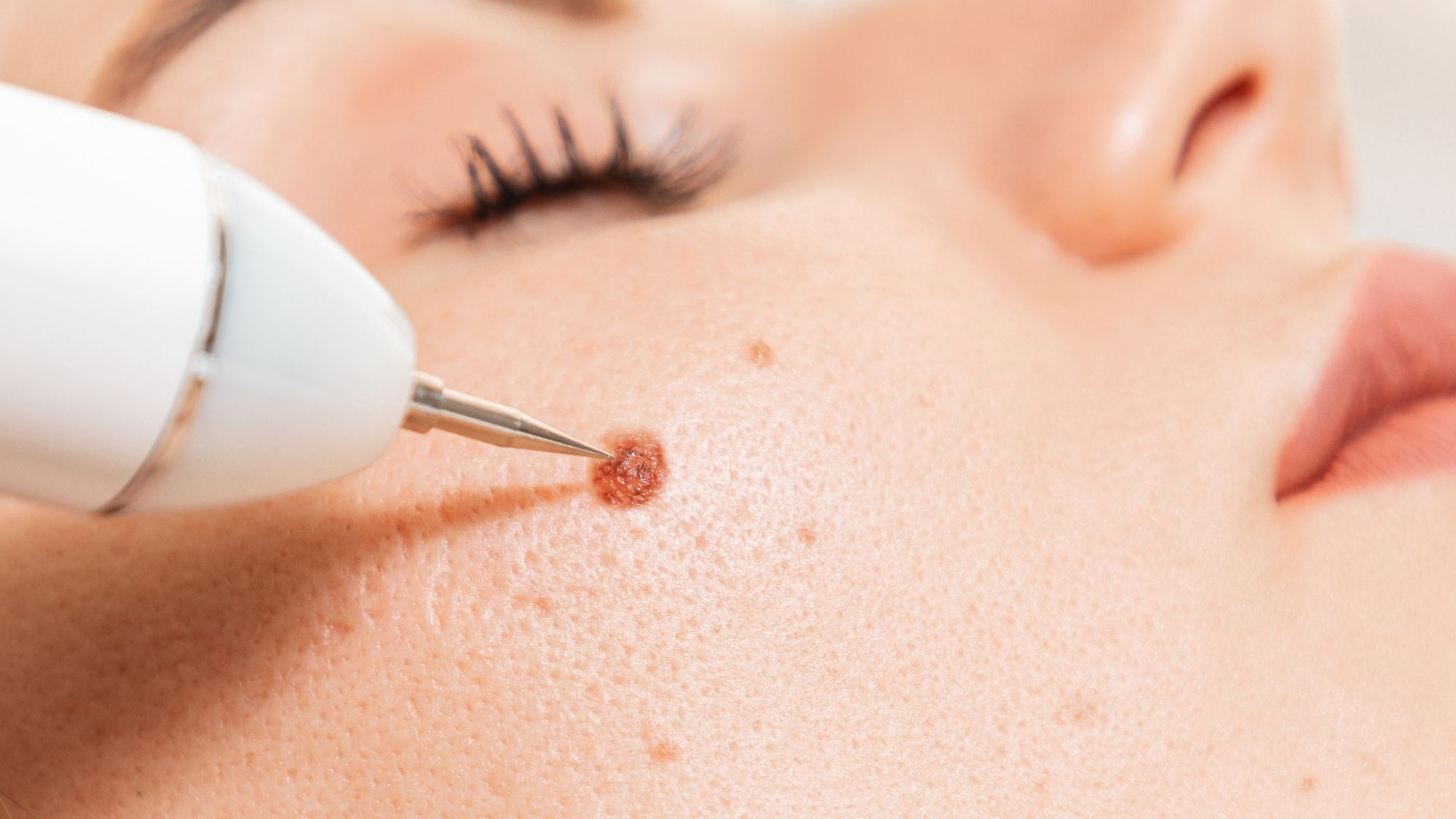 Elektrokoagulacja usuwanie zmian skórnych Warszawa