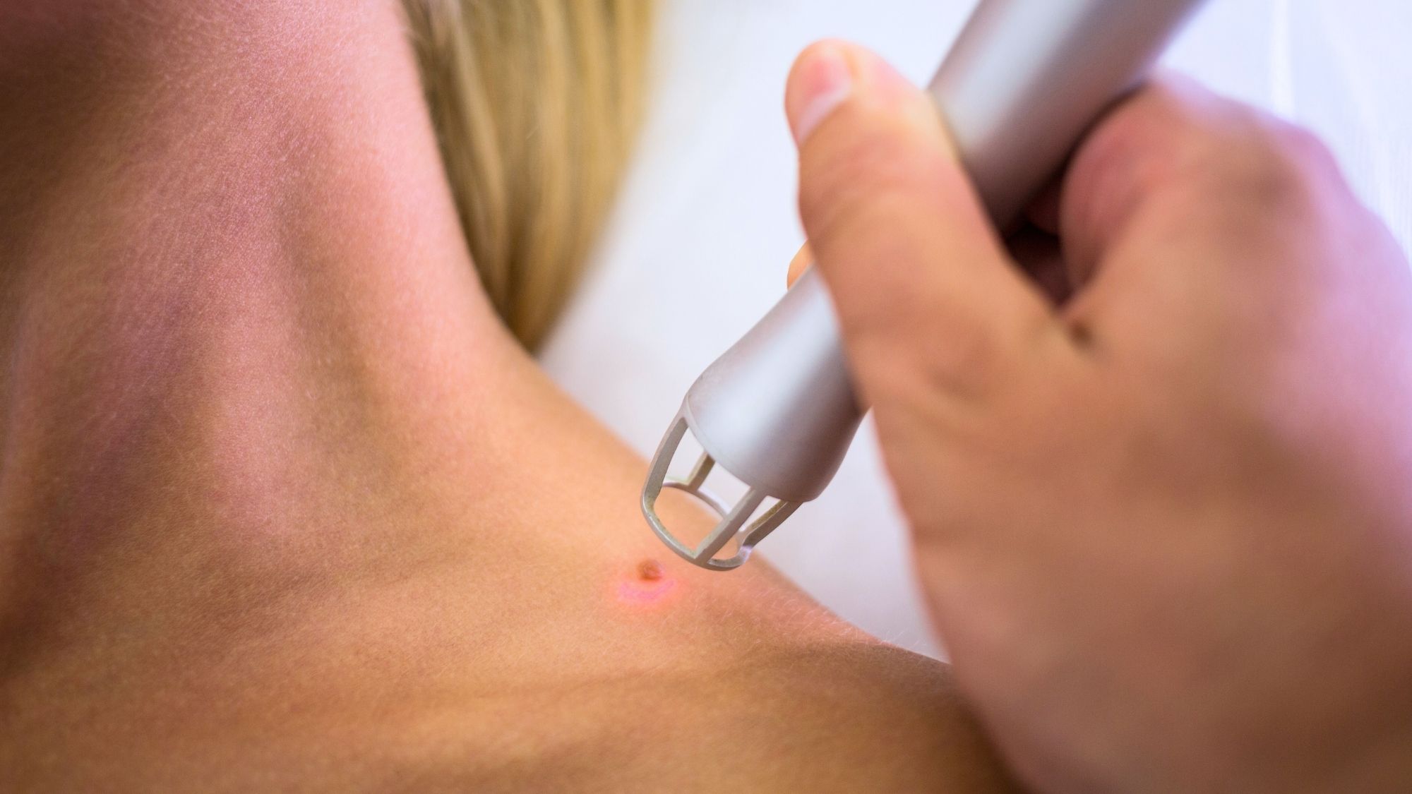 Laserowe usuwanie zmian skórnych Warszawa Dagderm