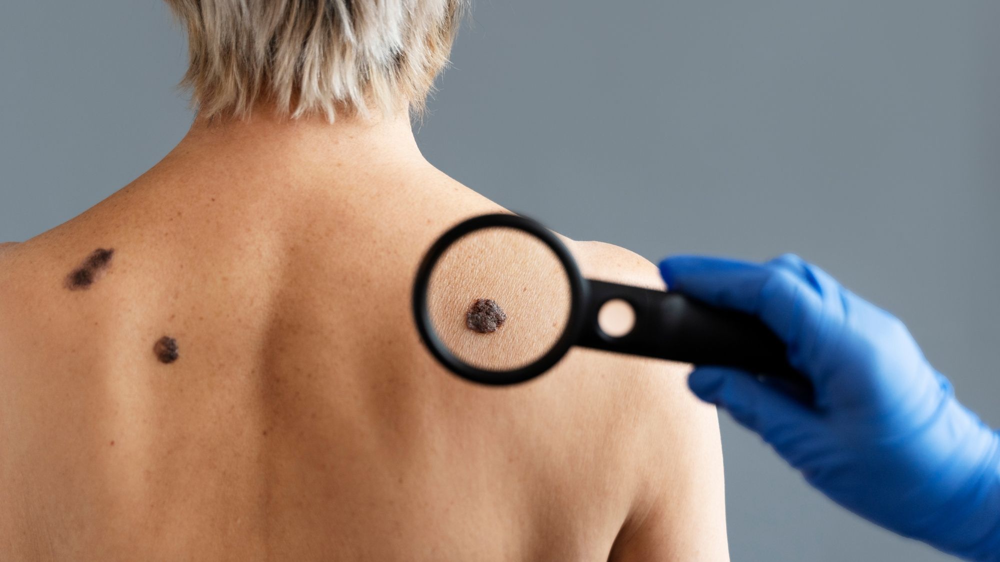 Usuwanie brodawek Warszawa konsultacja