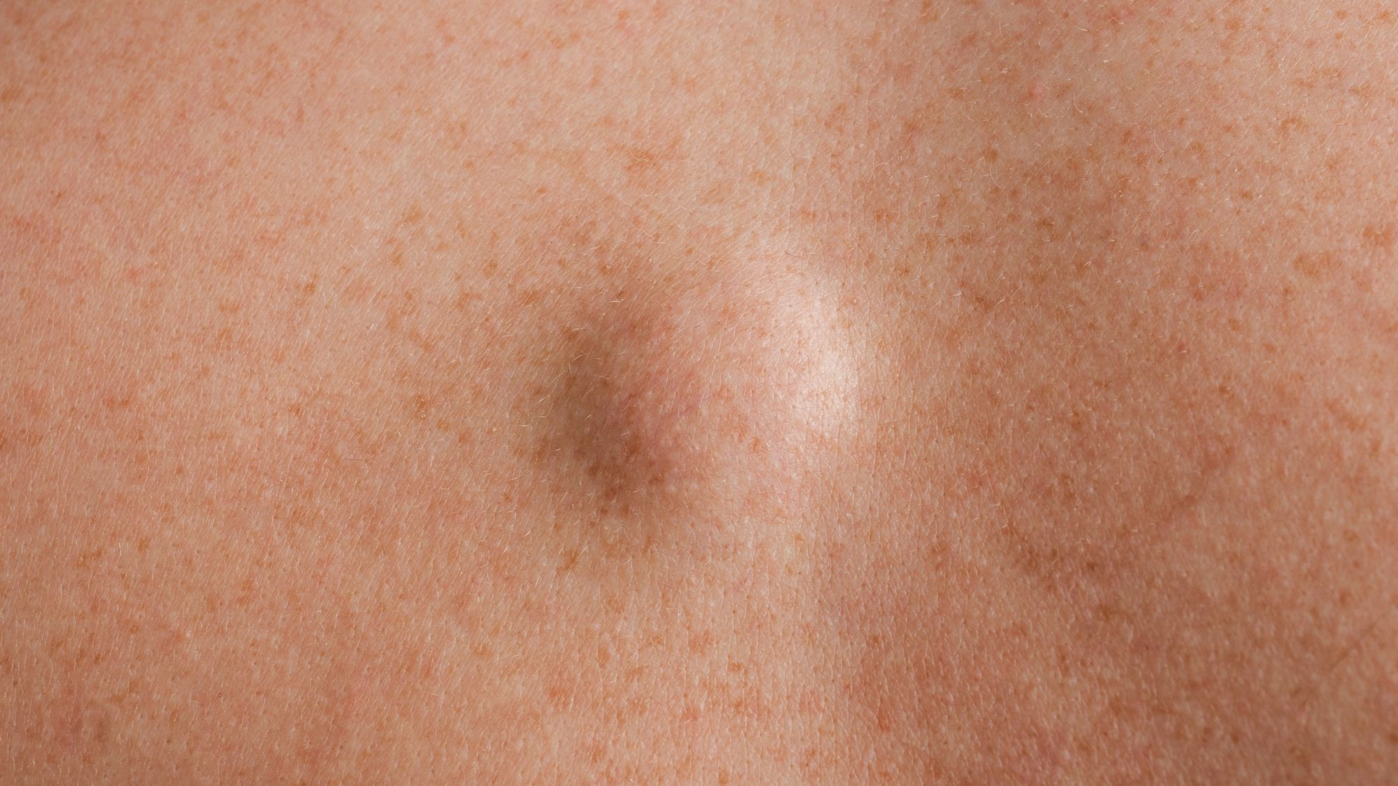 Usuwanie kaszaków i tłuszczaków Warszawa dermatolog