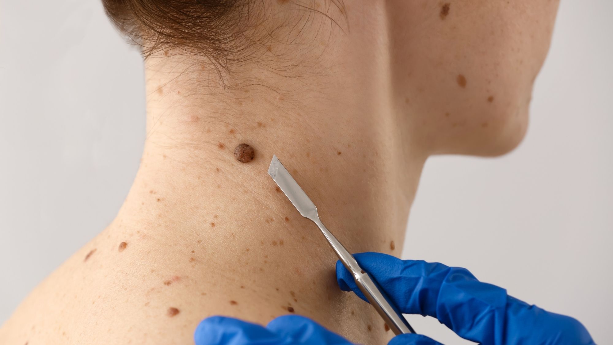 Usuwanie włókniaków Warszawa dermatolog